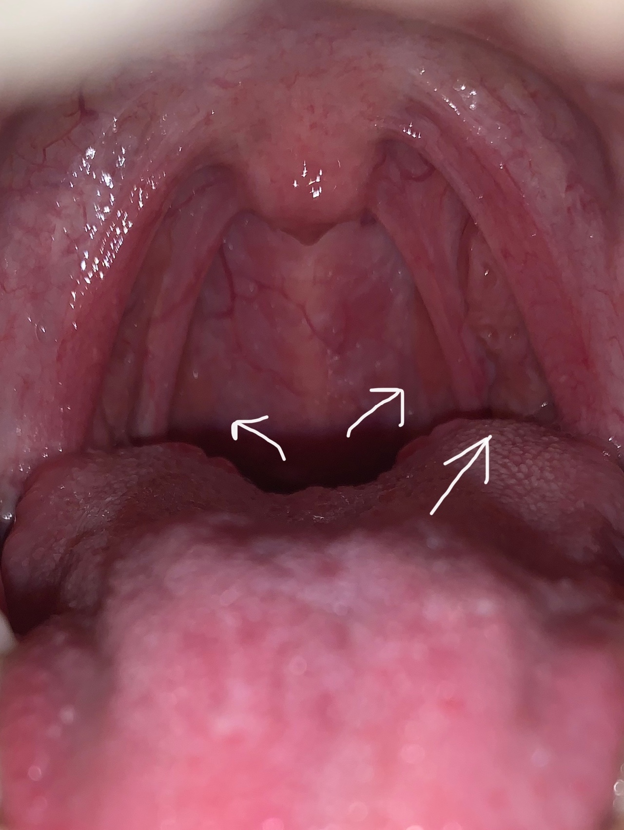 Опухла задняя стенка горла фото
