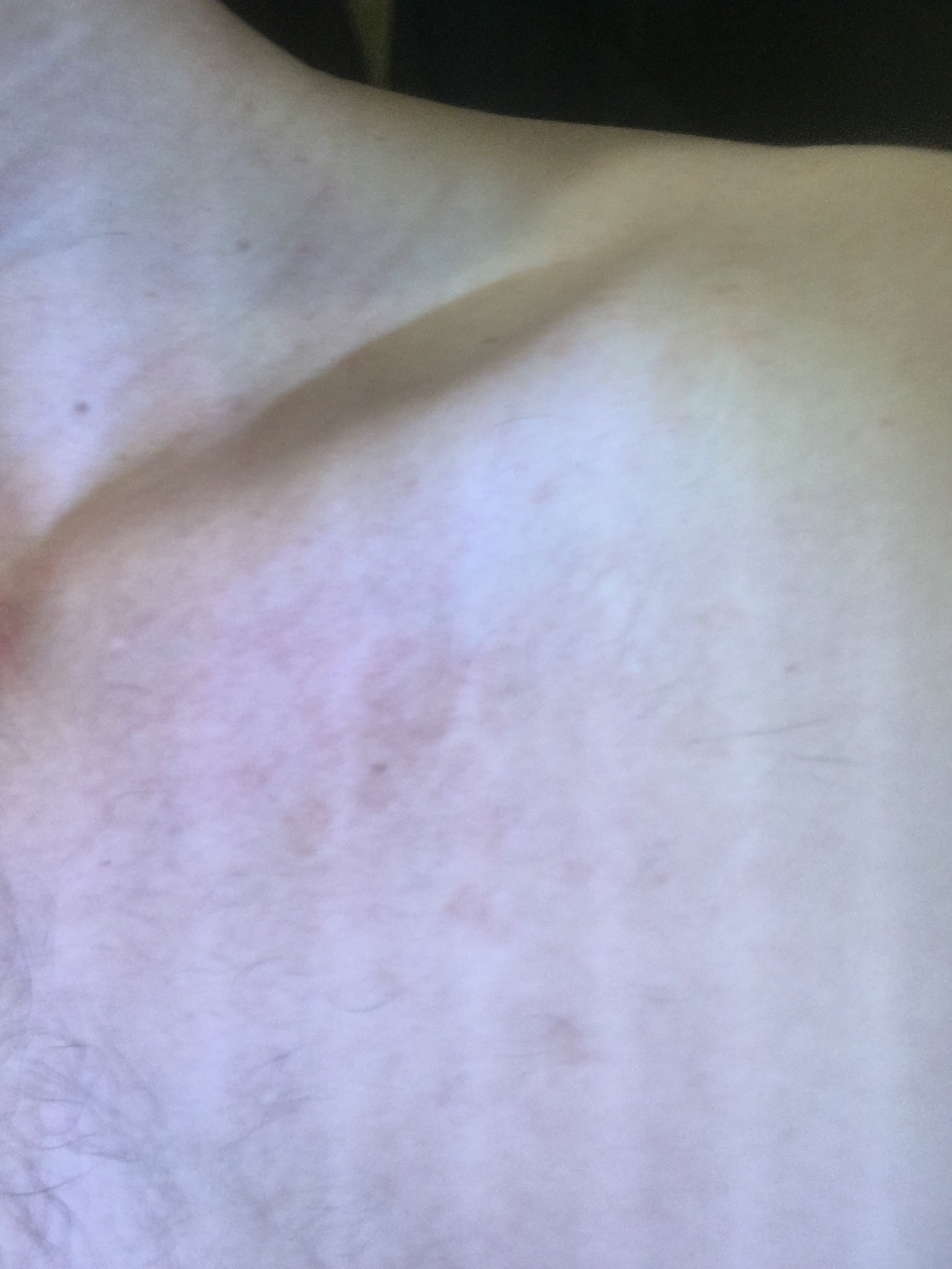 светло коричневые пятна на груди у женщин фото 116