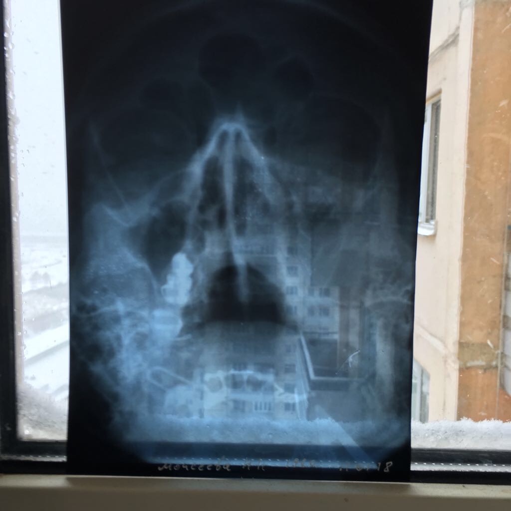 Рентген носа