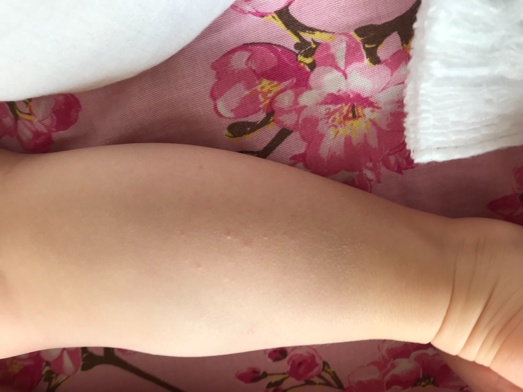 Красная сыпь на ножках у ребенка 1 год