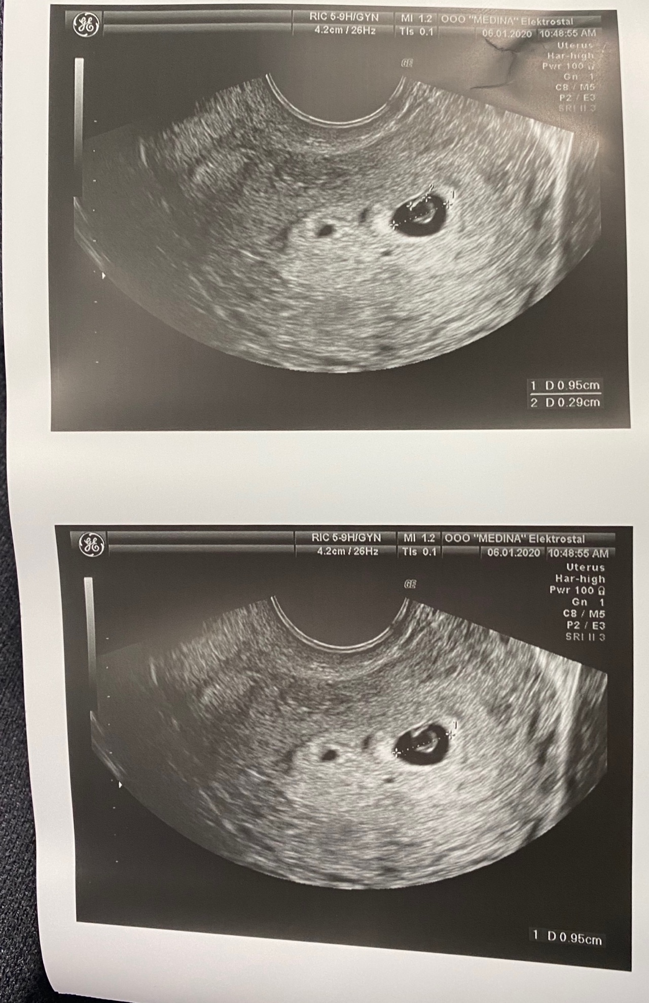 5 недель 3 дня беременности фото