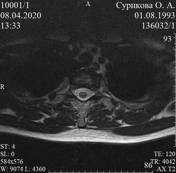 Фото кт грудного отдела