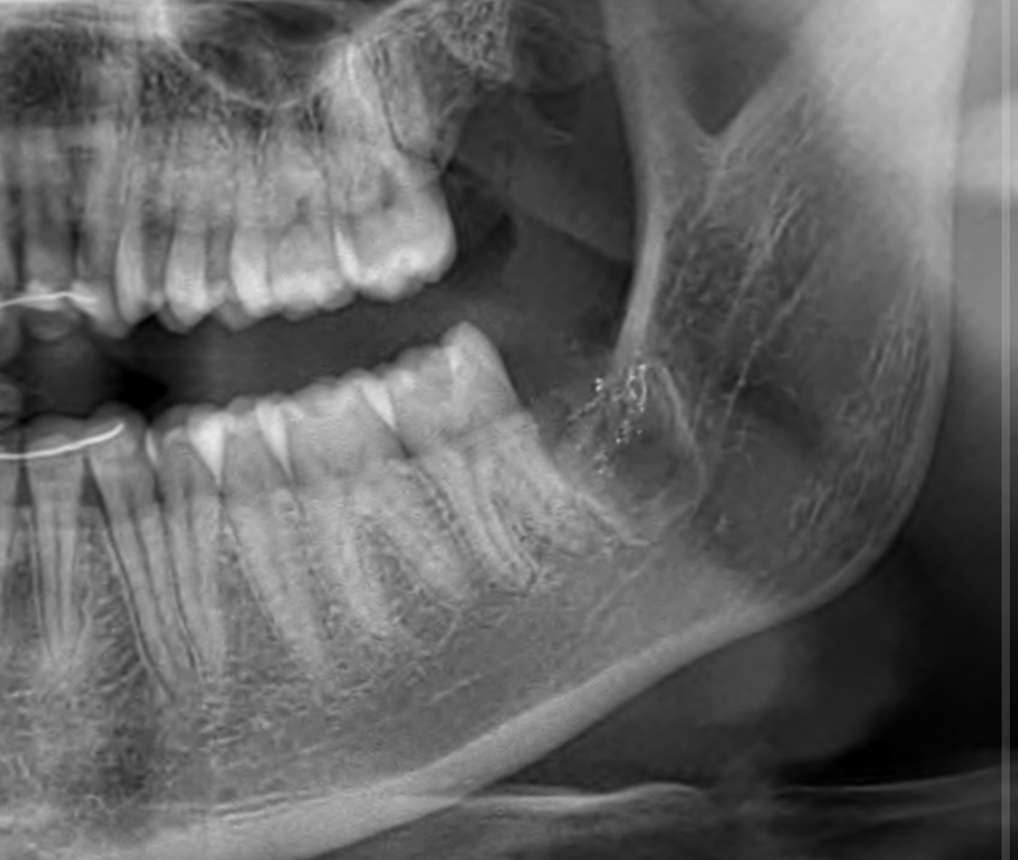 Рентген зуба мудрости фото