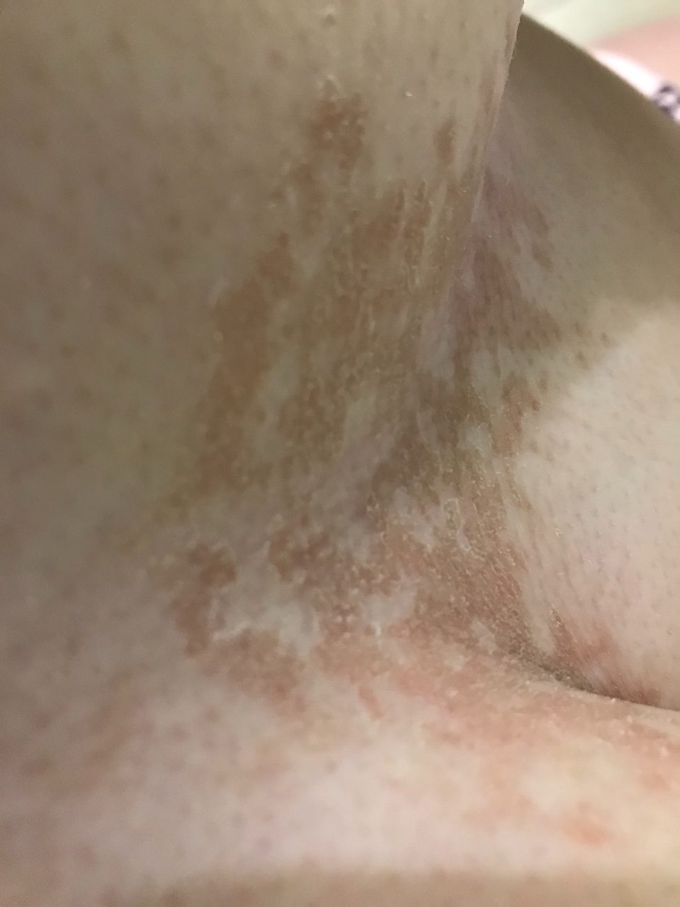 сыпь между грудей у женщин фото 75
