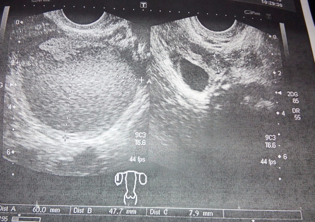 Эндометриоз яичника фото