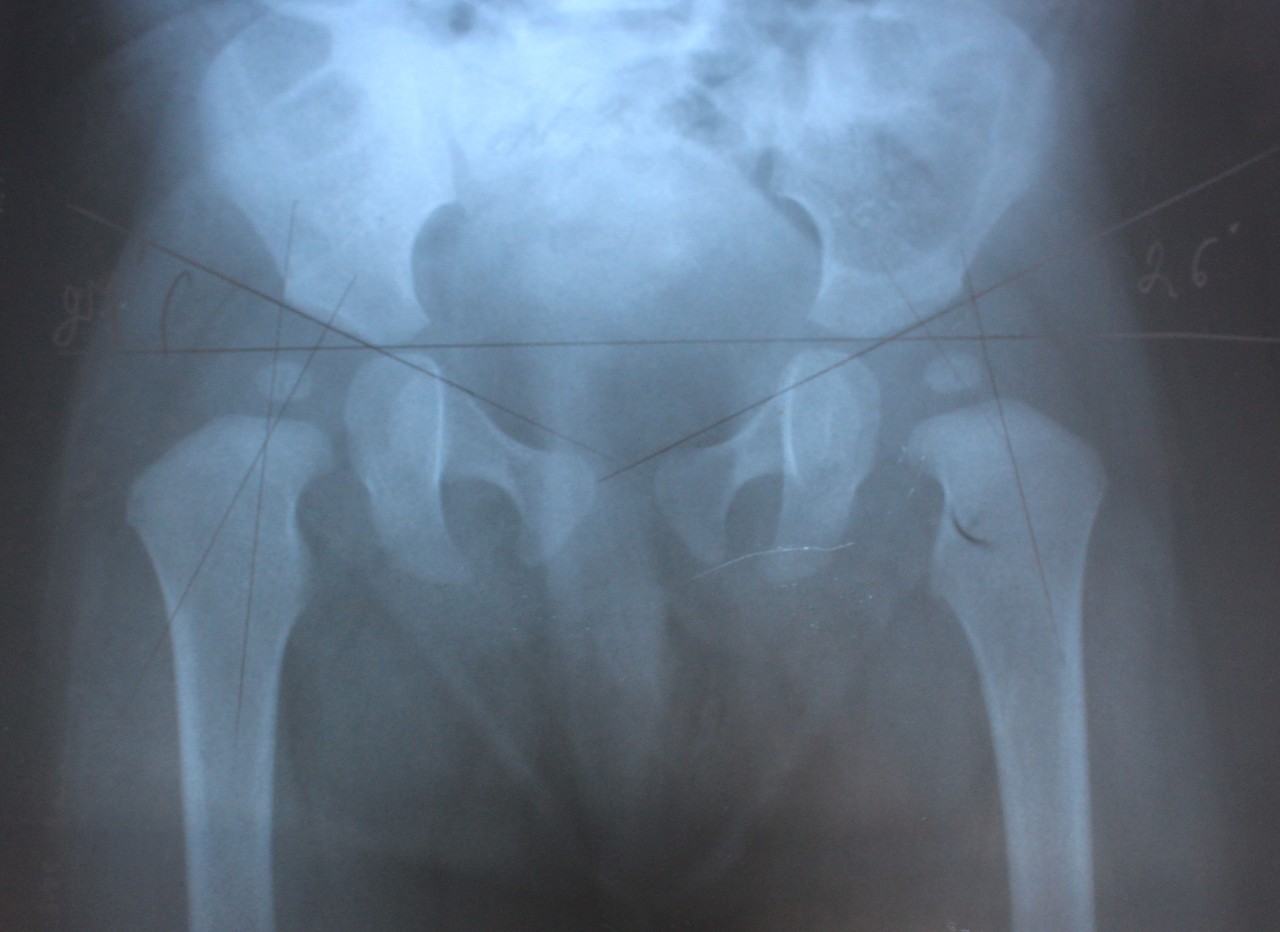 Что такое тбс. Врожденный вывих тазобедренного сустава рентген. ТБС тазобедренного сустава. Подвывих тазобедренного сустава у детей рентген.
