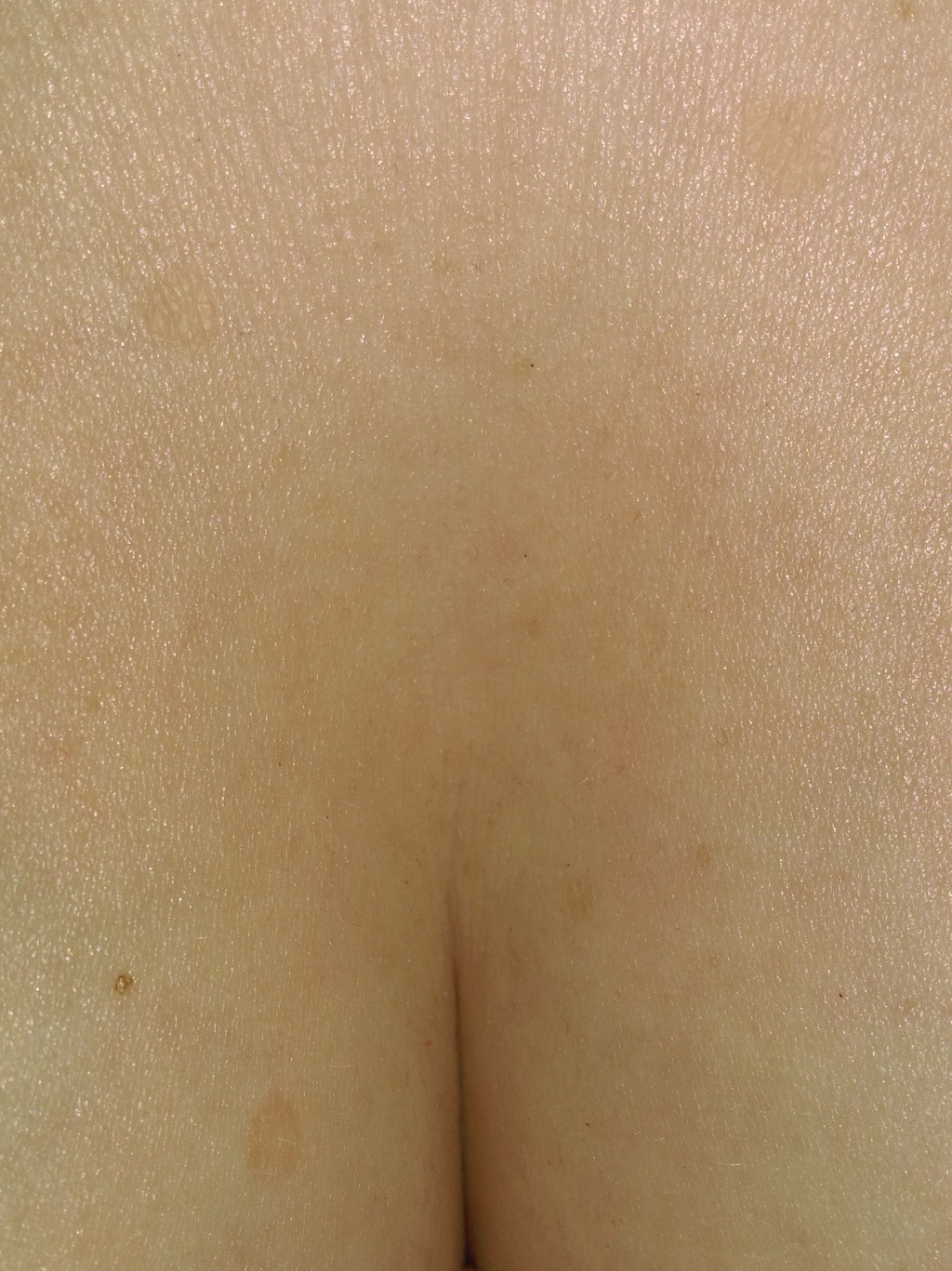 светлые пятна на груди женщин фото 67
