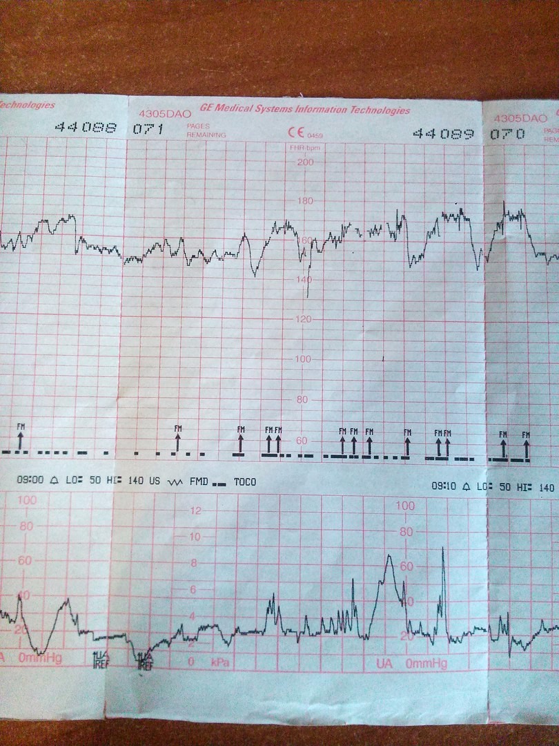 Ктг расшифровка. КТГ при беременности. КТГ на 36 неделе беременности. Идеальное КТГ.