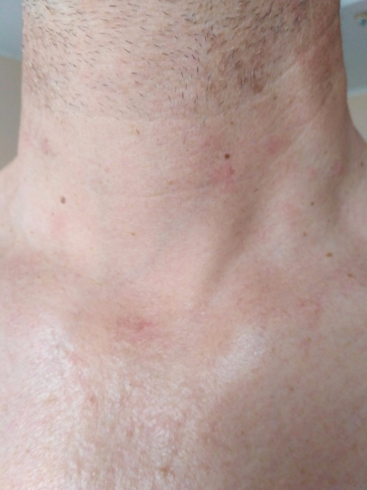 покраснение кожи груди мужчин фото 106