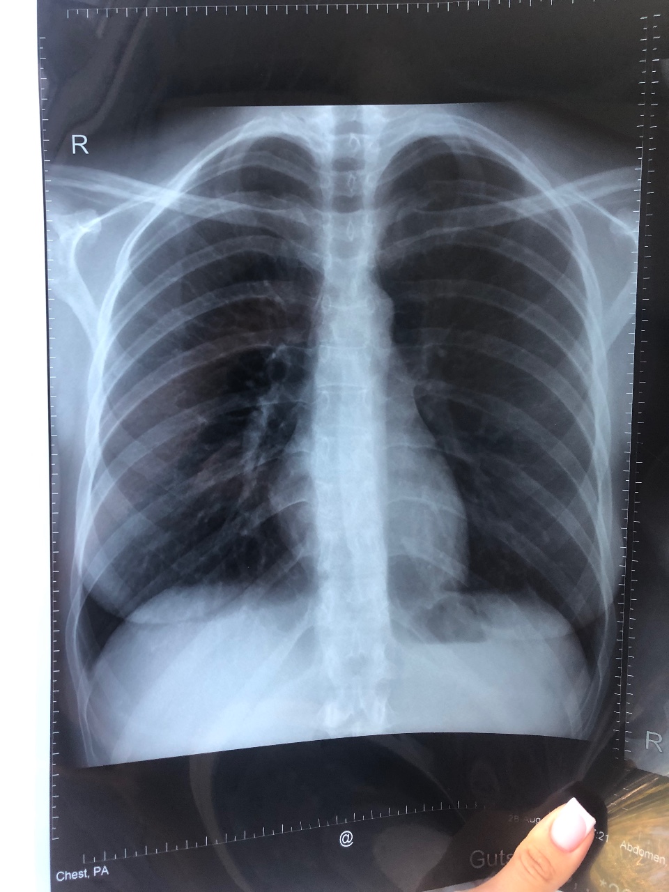силиконовая грудь на рентгене фото 60