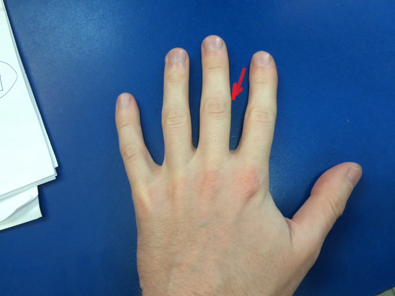 Межфаланговые суставы пальцев рук