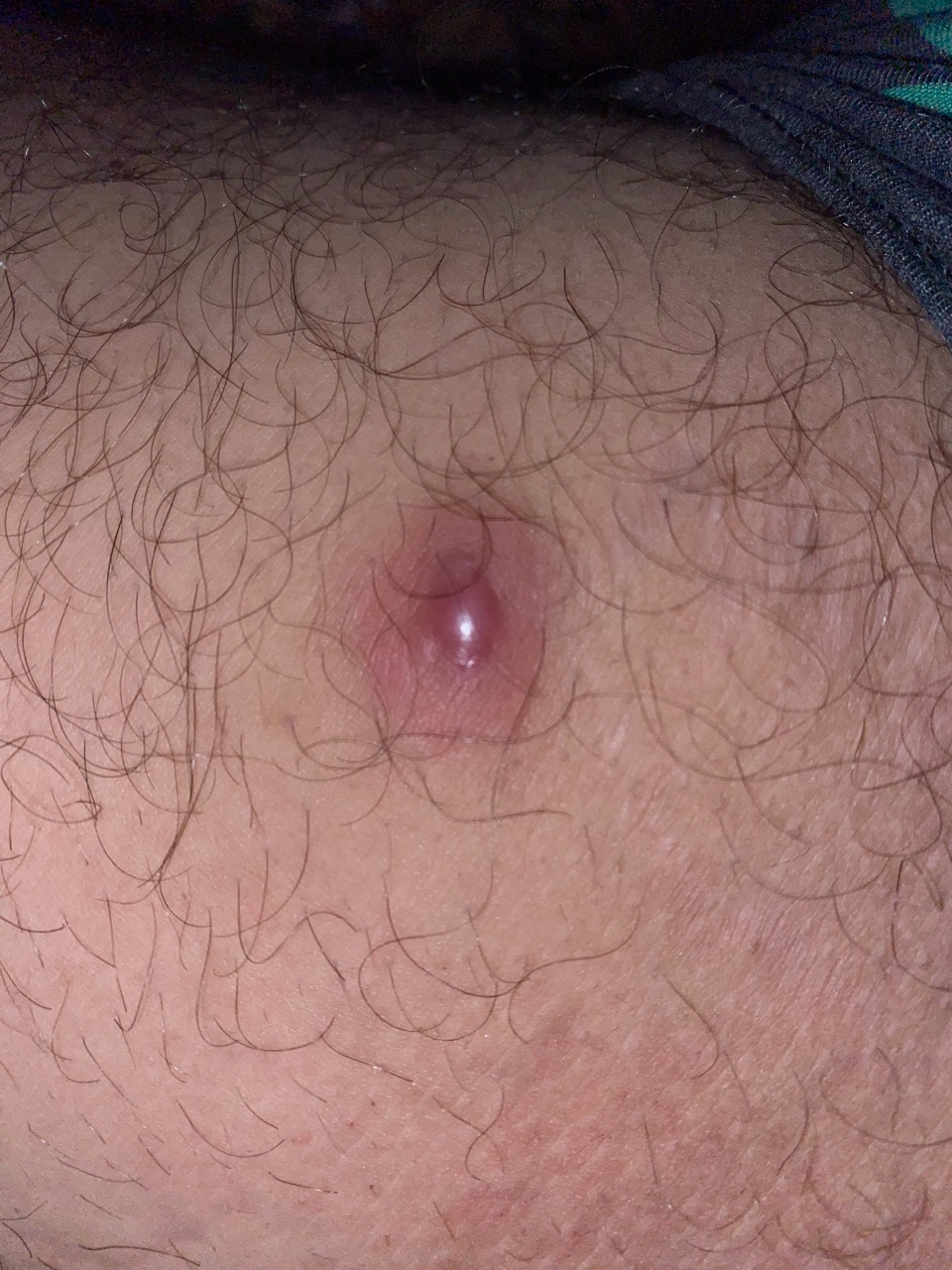 фурункул на груди у женщин лечение фото 81