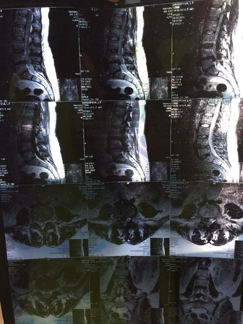 Протрузии дисков l4-l5 l5-s1. Экструзия диска l5-s1 что это такое. Дорзальная грыжа l5 s1. Грыжа между 4 и 5 позвонком. Грыжа между 4 и 5 позвонком.