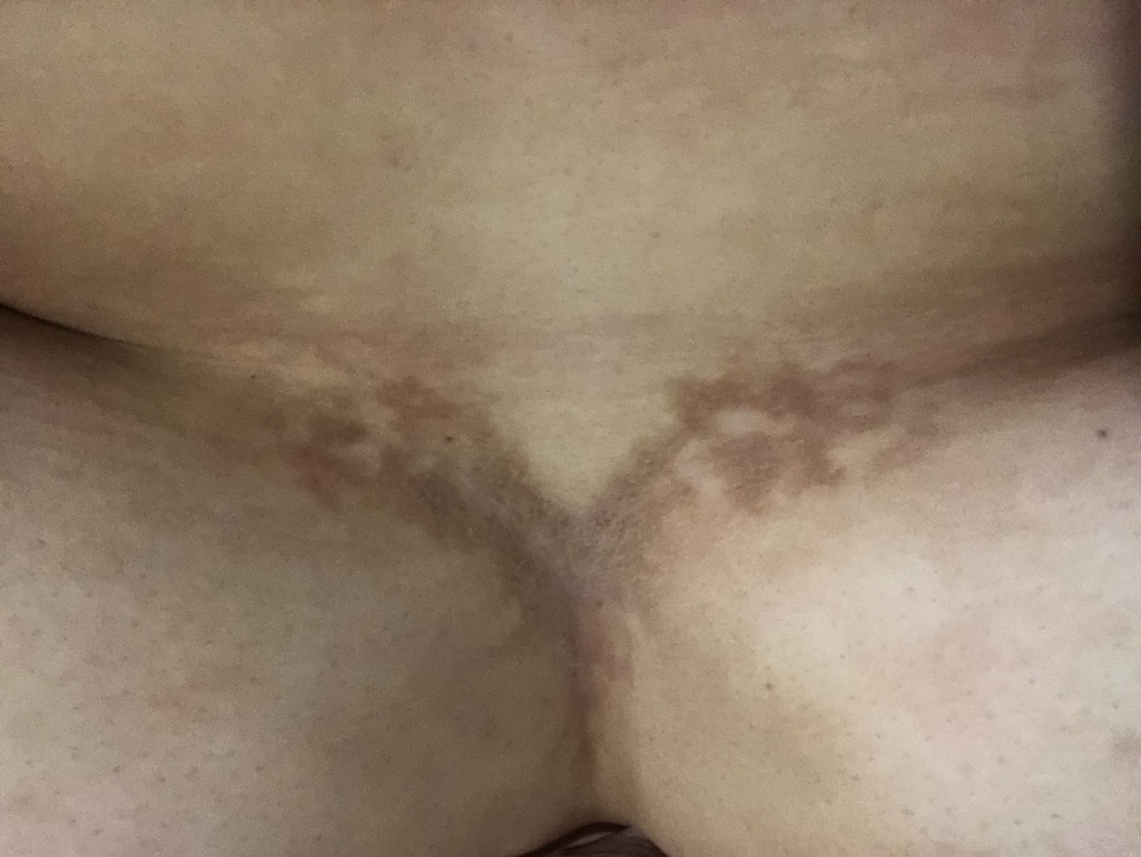 светло коричневые пятна на груди у женщин фото 113