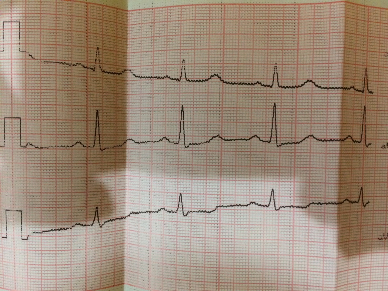 Как выглядит здоровая кардиограмма сердца фото