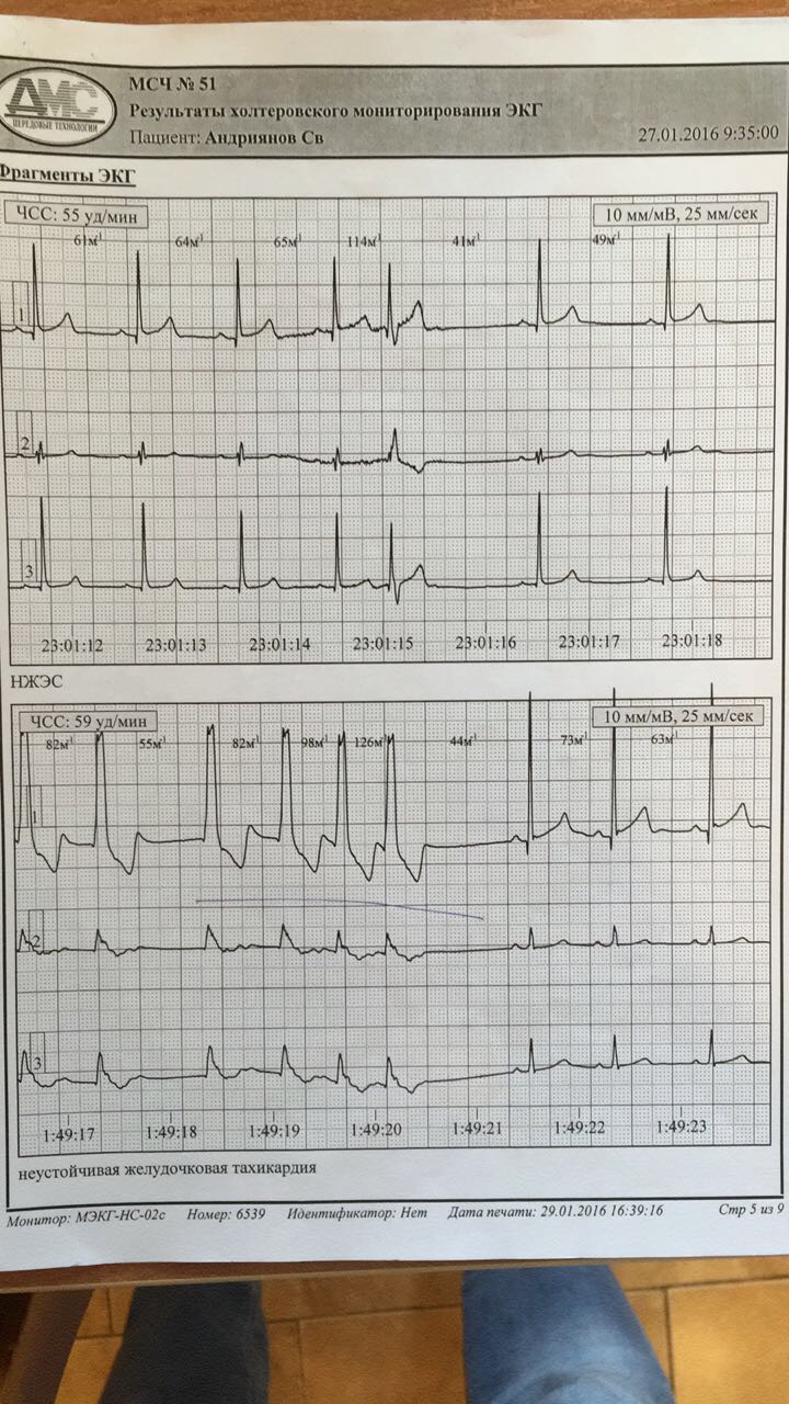 Экг при тахикардии фото