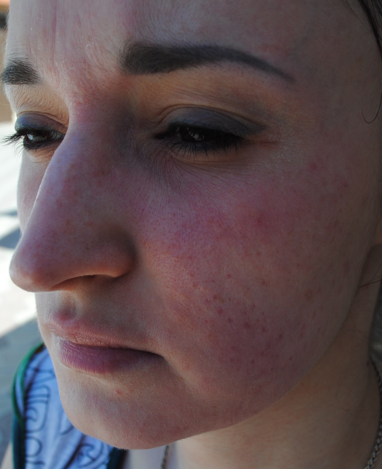Сыпь на лице в течении 2-х лет, похожая на экзему - Вопрос дерматологу .