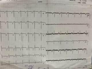 Расшифровка кардиограммы сердца по фото