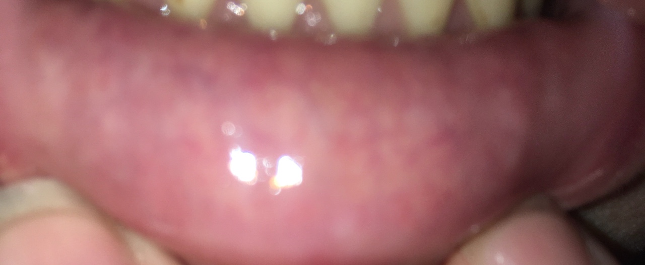 Лейкоплакия губы фото