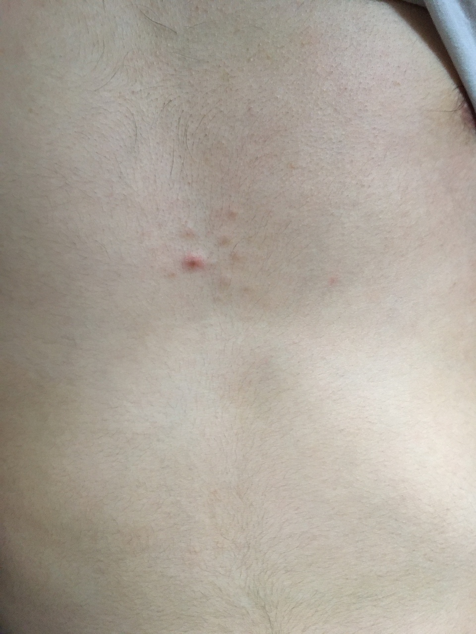 небольшое уплотнение у мужчин в груди фото 48
