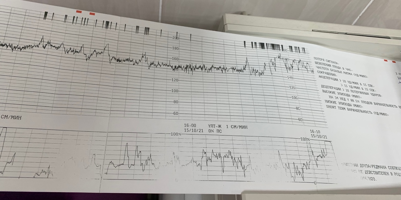 Ктг на 39 неделе беременности