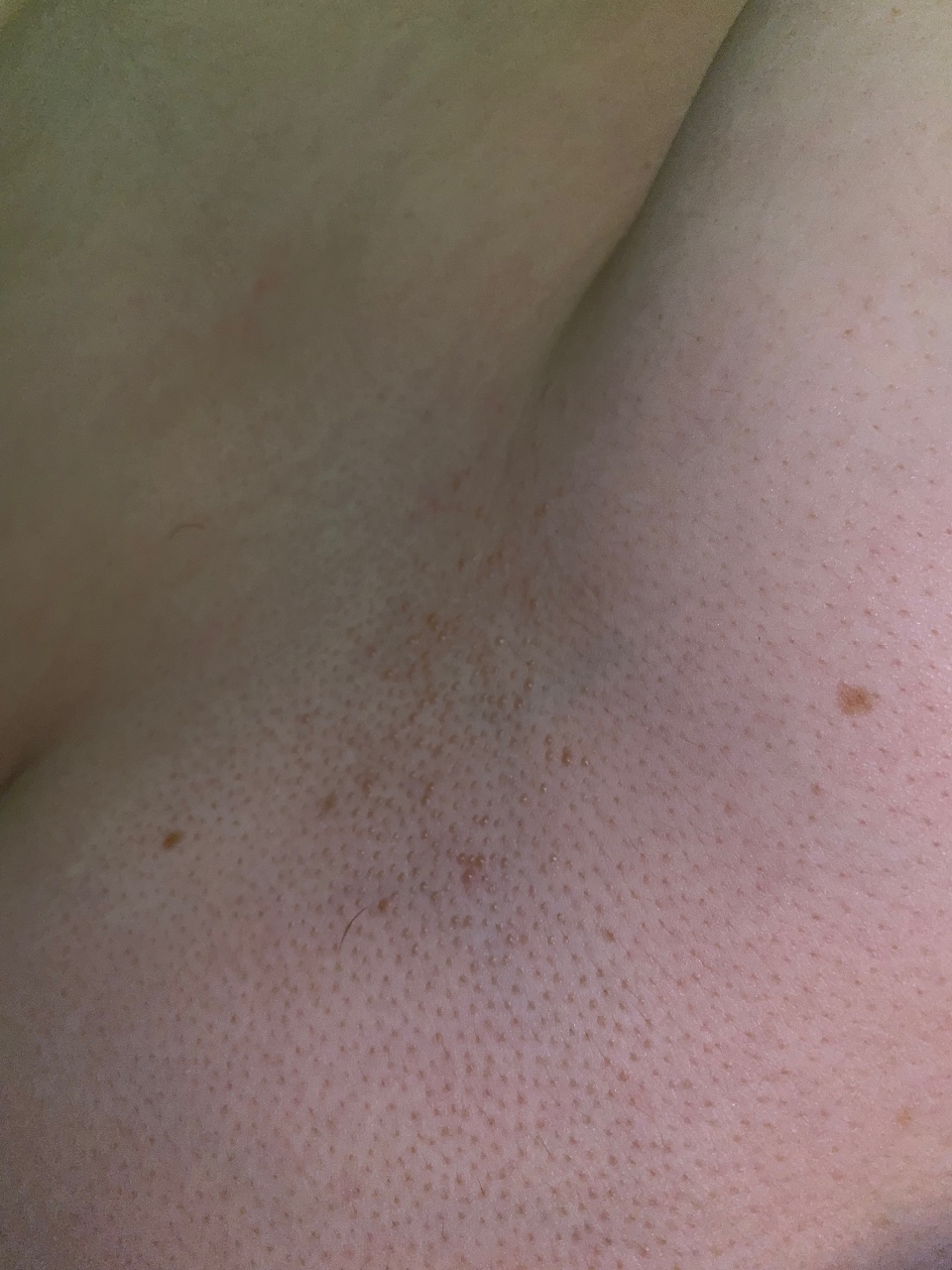 сыпь между грудей у женщин фото 22