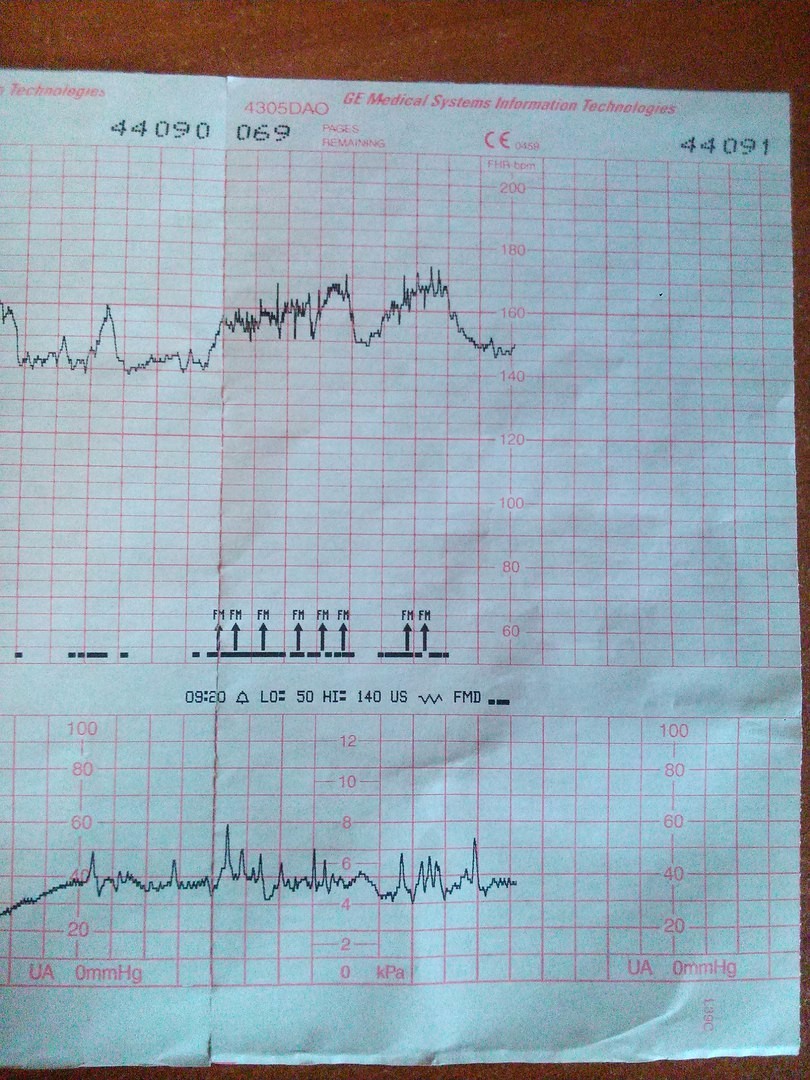 Ктг неделям. КТГ на 36 неделе беременности. КТГ расшифровка. Нормальное КТГ на 36. КТГ плода при беременности норма 36 недель.