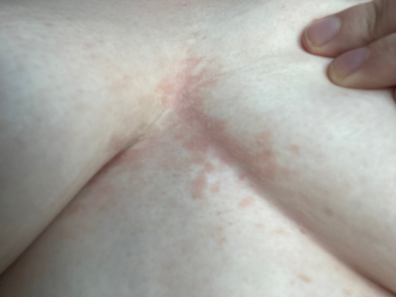 разрывы на грудях у женщин фото 83