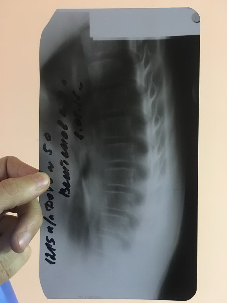 Перелом грудного отдела позвоночника. Компрессионный перелом позвоночника у детей грудного отдела рентген. Перелом грудного отдела. Компрессионный перелом грудного отдела. Компрессионный перелом у детей рентген.