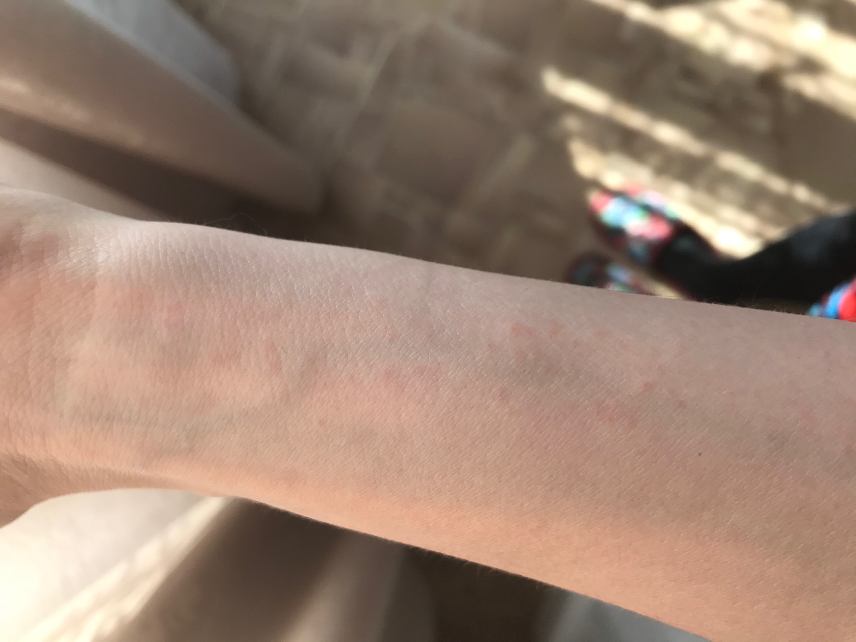 Красная сыпь на ногах и руках Вопрос дерматологу 03 Онлайн