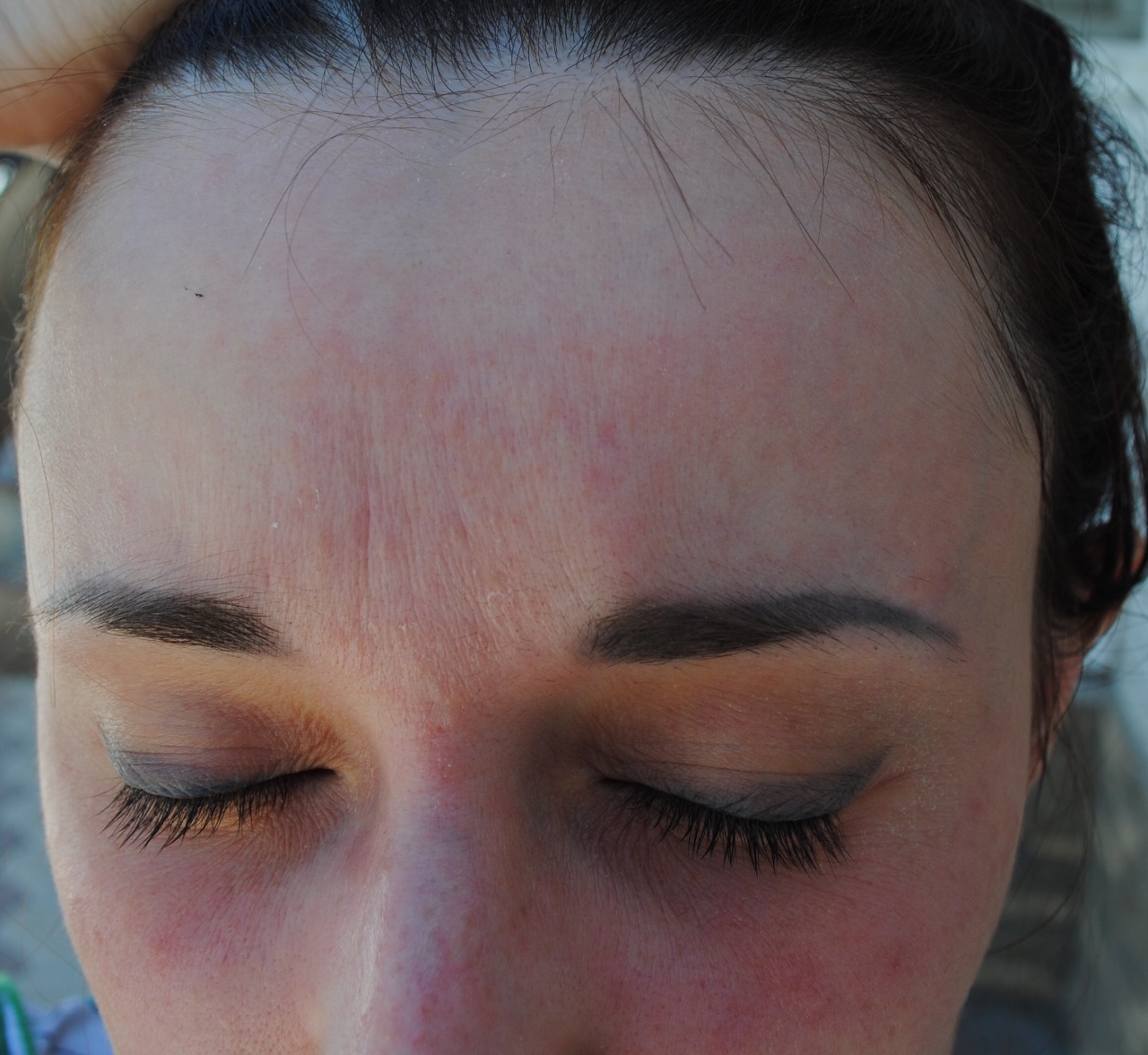 Сыпь на лице в течении 2-х лет, похожая на экзему - Вопрос дерматологу .