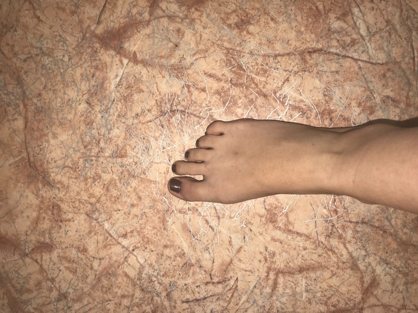 пигментация кожи на ногах фото