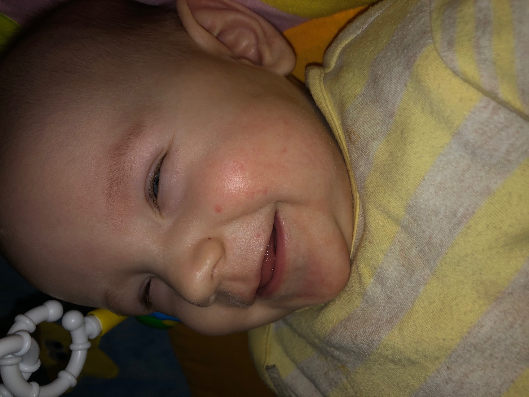 Сыпь на щечках у ребенка 3 месяца
