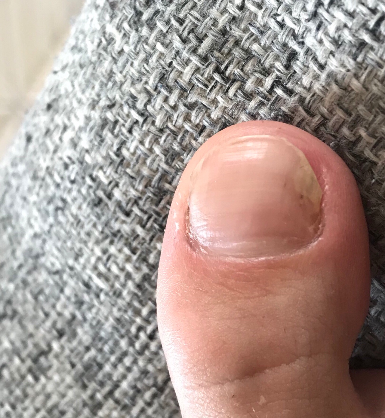 Как выглядит грибок ногтей на ногах фото