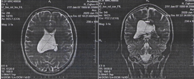 Фото киста головного мозга