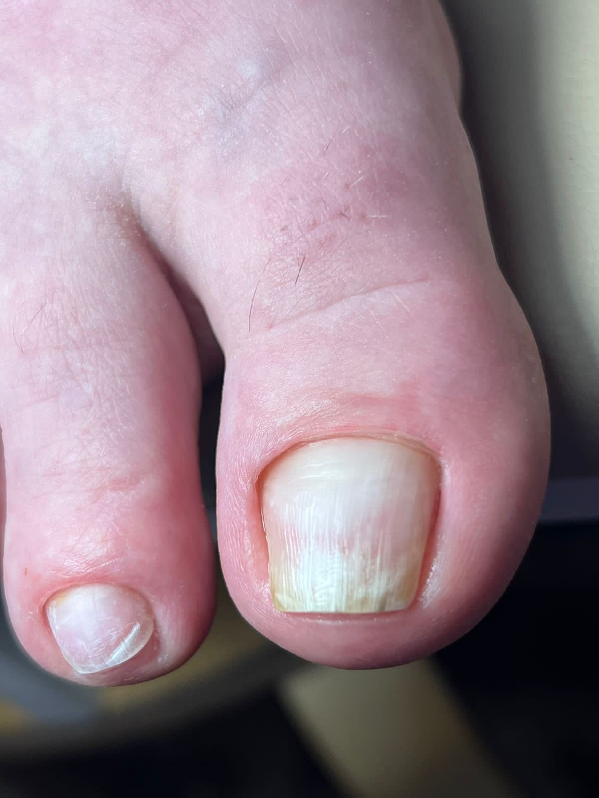 Трещины на ногтях - Вопрос подологу - 03 Онлайн