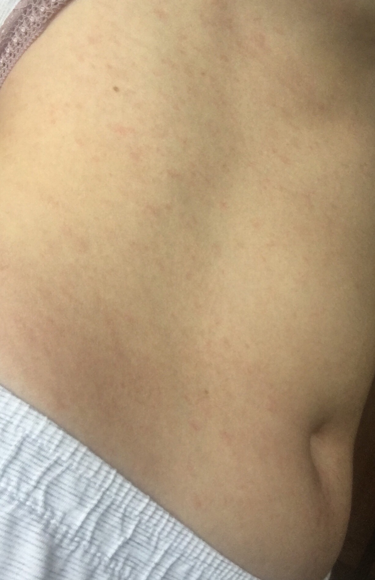 аллергическая сыпь на животе фото