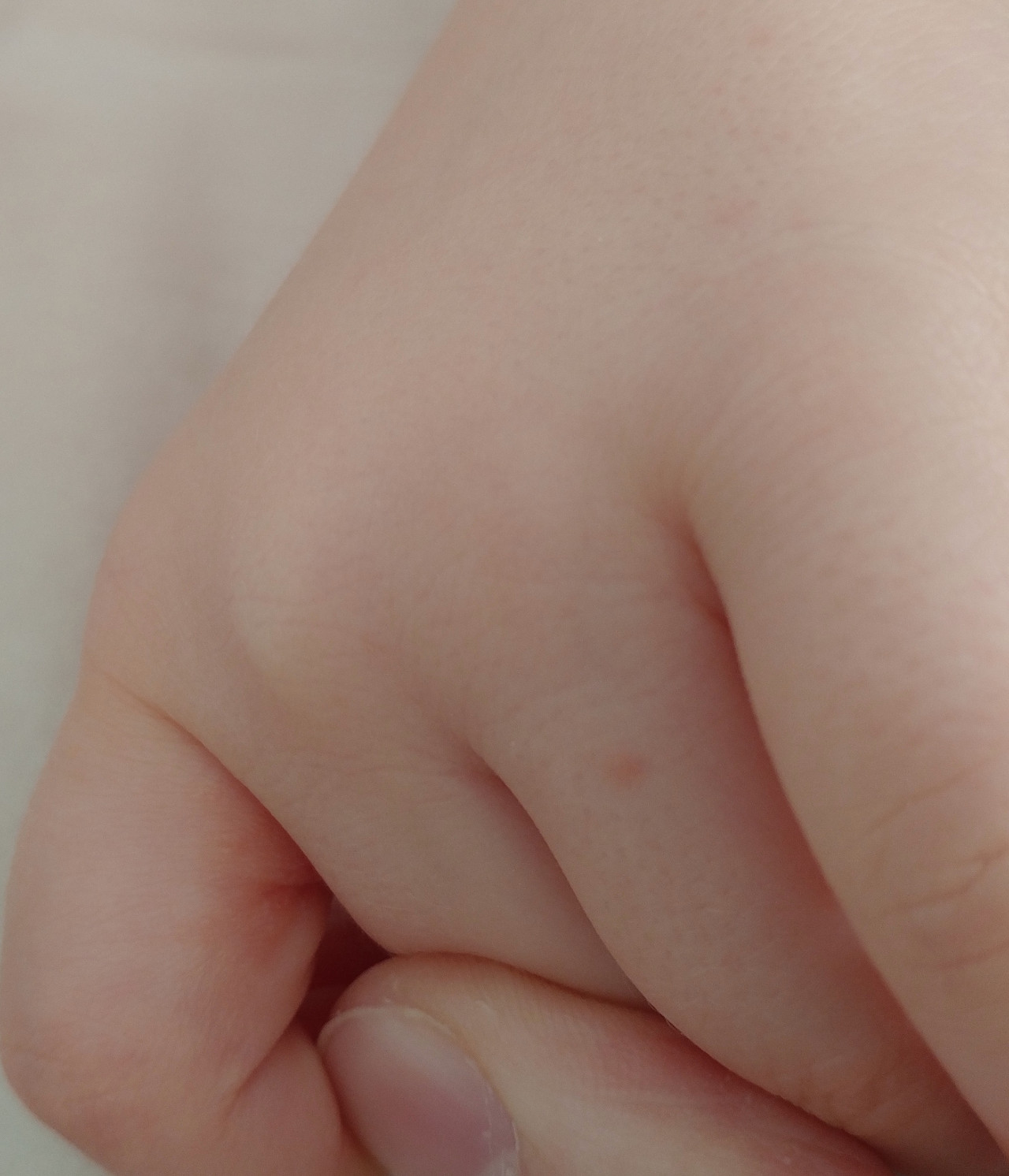 Мелкая сыпь между пальцами у ребенка