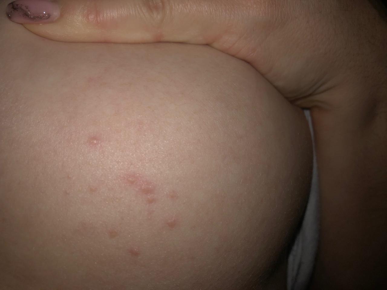 сыпь на коже груди у женщин фото 92