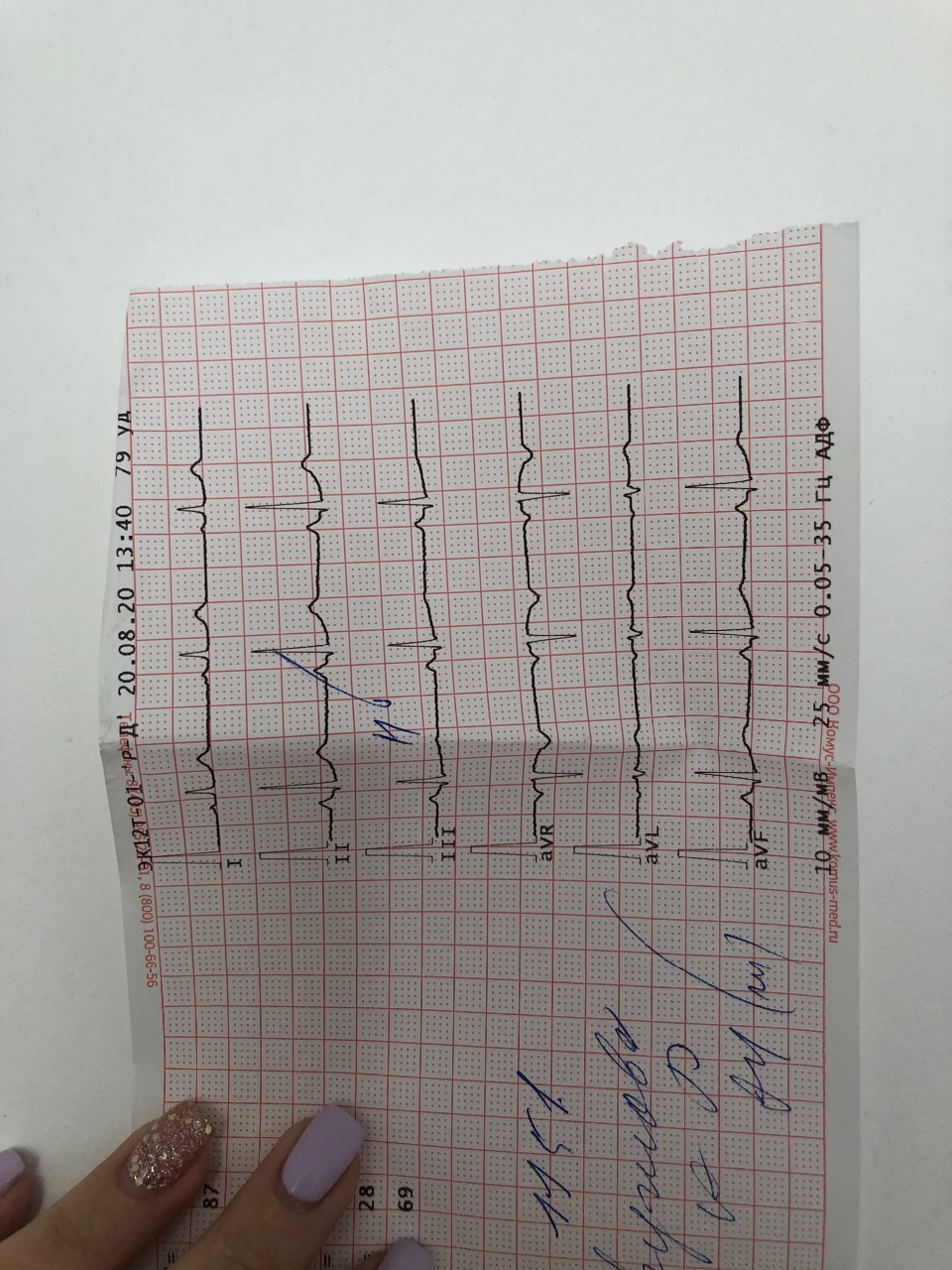 Нбпнпг это. НБПНПГ на ЭКГ. Результаты ЭКГ. Результаты ЭКГ расшифровка. Как делают кардиограмму.