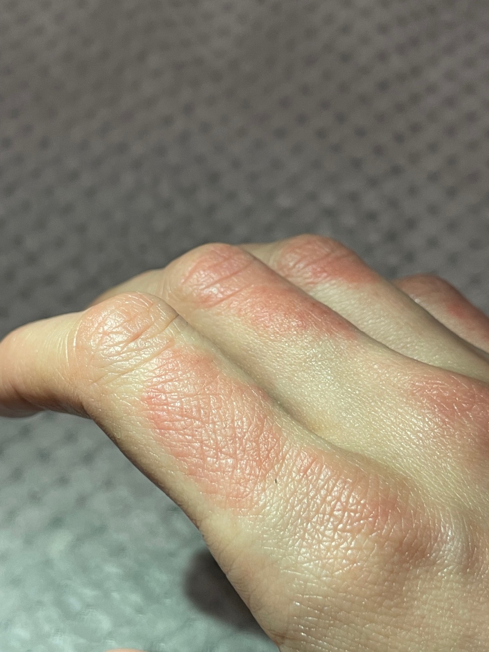 грибок между пальцев руки фото
