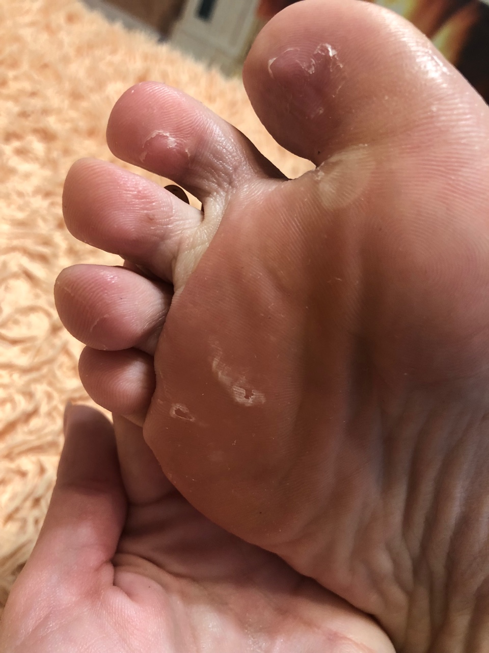 Облазит кожа на пальцах ног