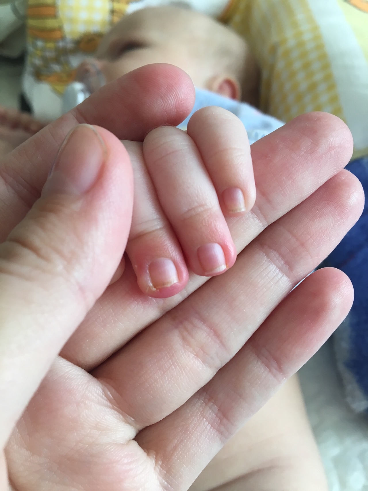 Пальчики грудничков. Ногти у новорожденных детей. Прыщики на пальцах у грудничка. Панариций у новорожденного ребенка.