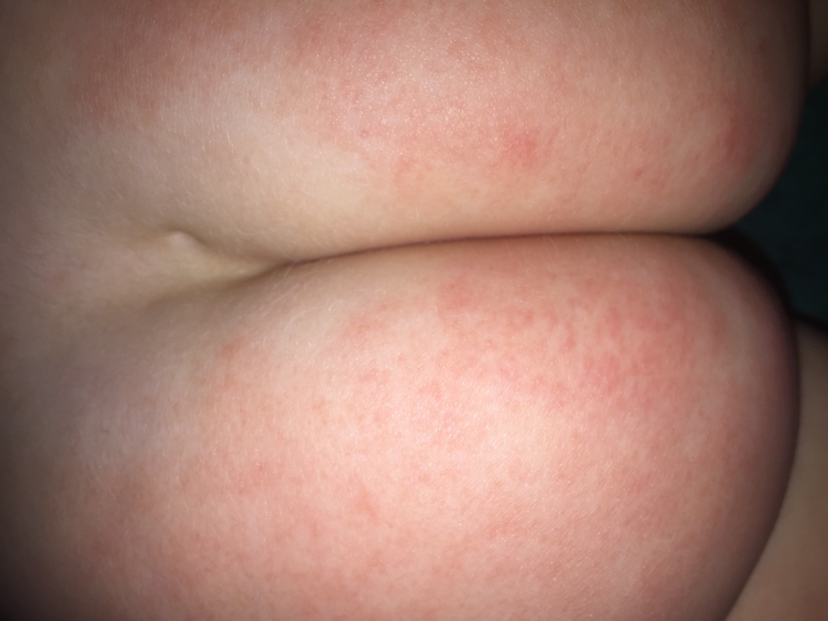 дерматит под грудями фото фото 9