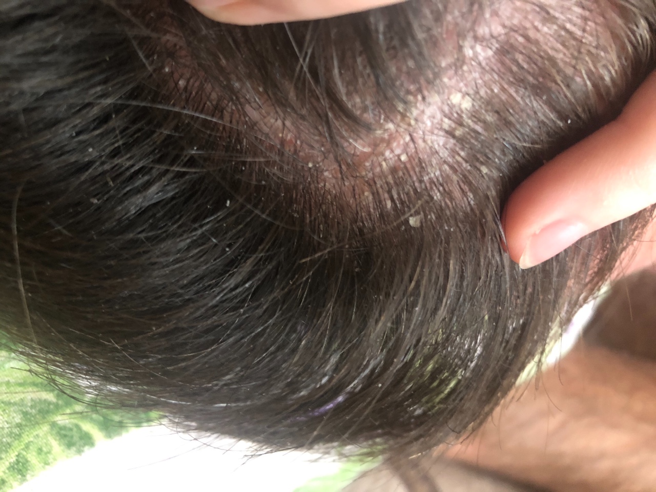 Мелкопластинчатое шелушение кожи головы