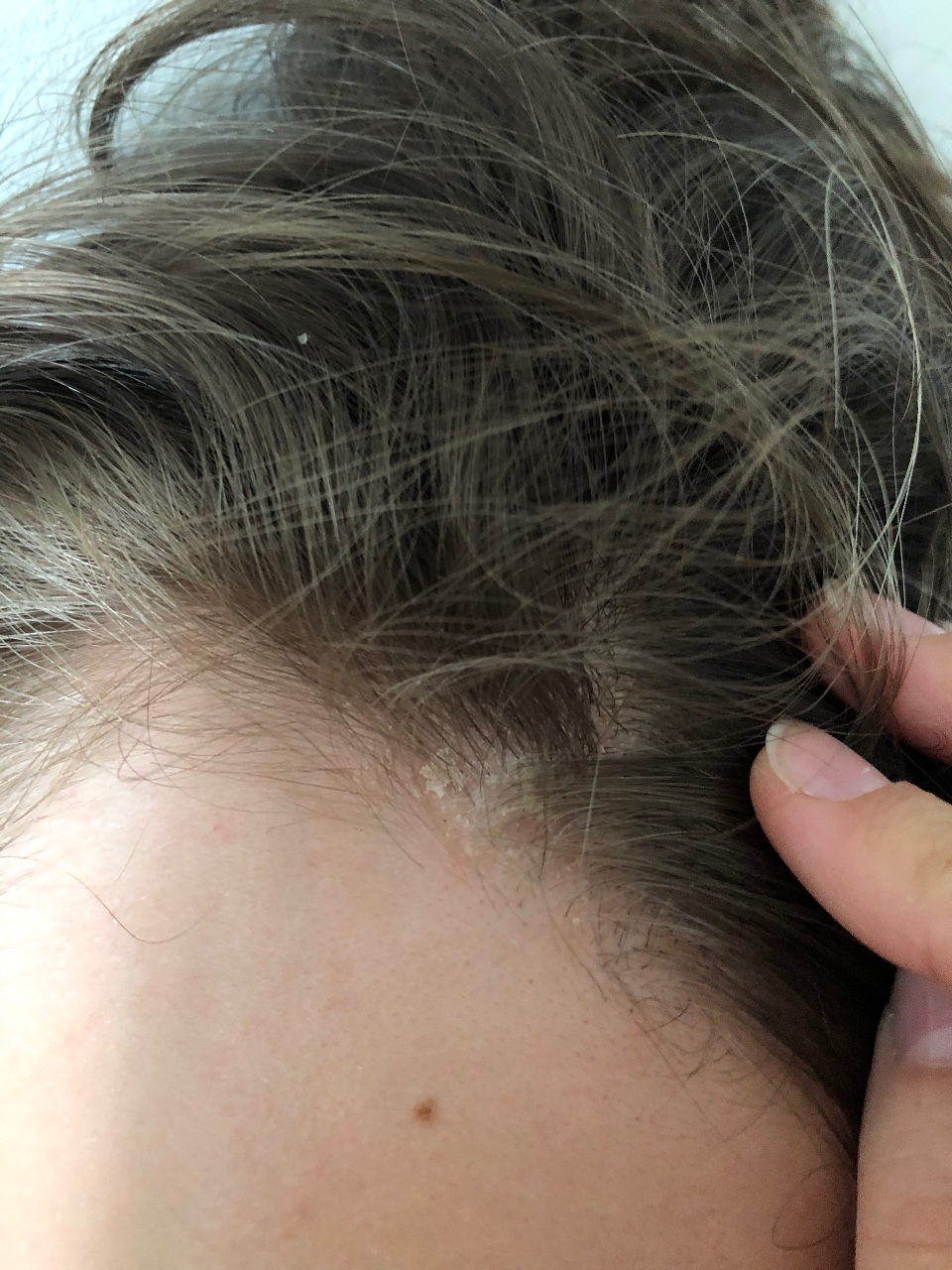 себорейный дерматит на голове у ребенка фото