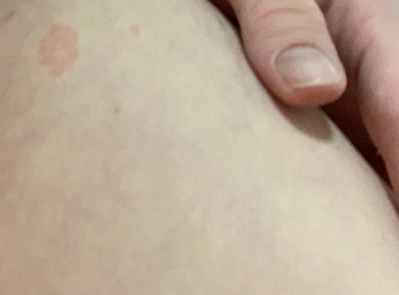 Аллергия при грудном вскармливании: причины появления, лечение, диета