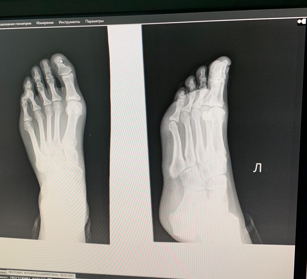 Ногтевой фаланги пальца ноги. Экзостоз 1 пальца стопы на рентгене. Экзостоз ногтевой фаланги 1 пальца стопы. Экзостоз пальца стопы рентген.