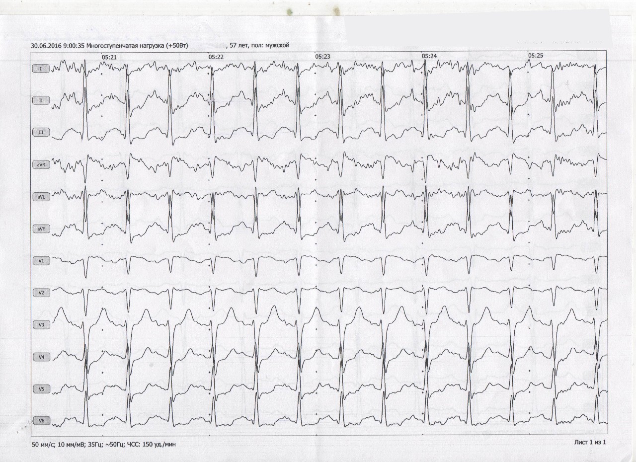 Экг с нагрузкой. Тренировочные ЭКГ. Кардиограммы для тренировки. ЭКГ С нагрузкой расшифровка. Нормальная ЭКГ С нагрузкой.