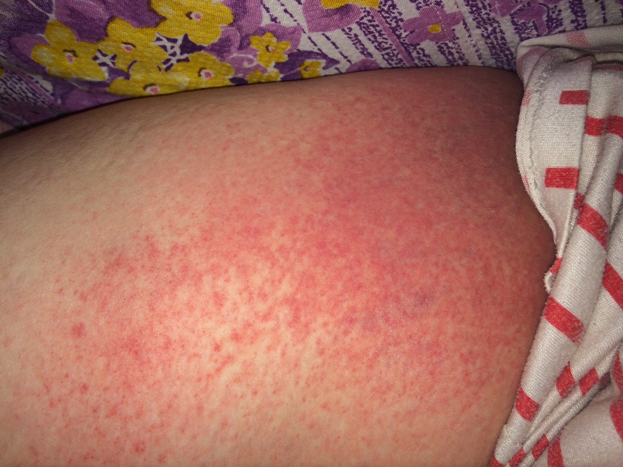 аллергия по телу по сперму фото 47